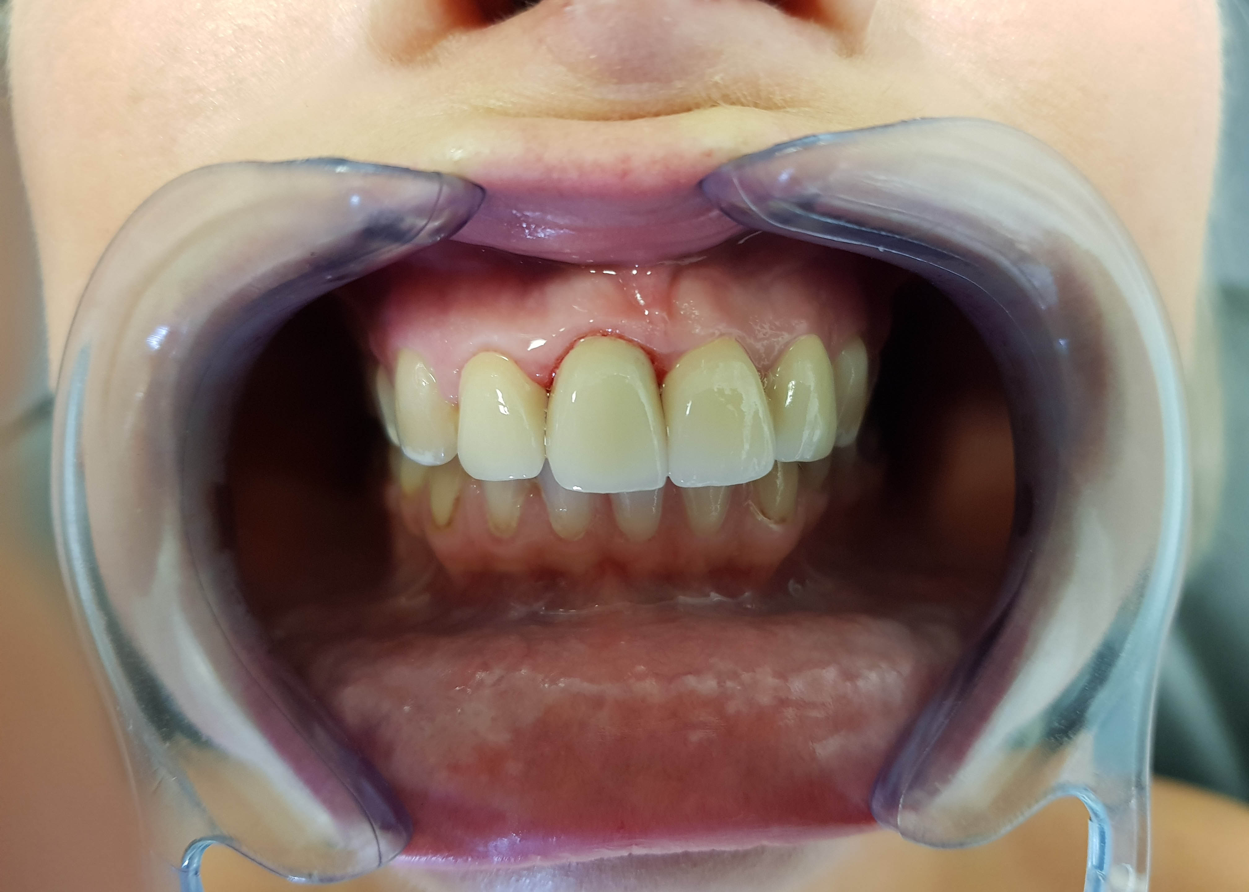 Tanden laten laseren